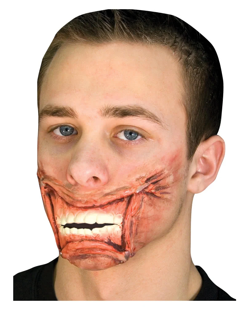 Mund Wunde Getackert 3 Mund Wunde Getackert